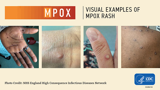 CDC Visual Examples of Monkeypox Rash - Visual 1