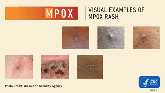 CDC Visual Examples of Monkeypox Rash - Visual 2